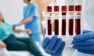 Nuovo test del sangue per l’Alzheimer che identifica biomarcatori strutturali